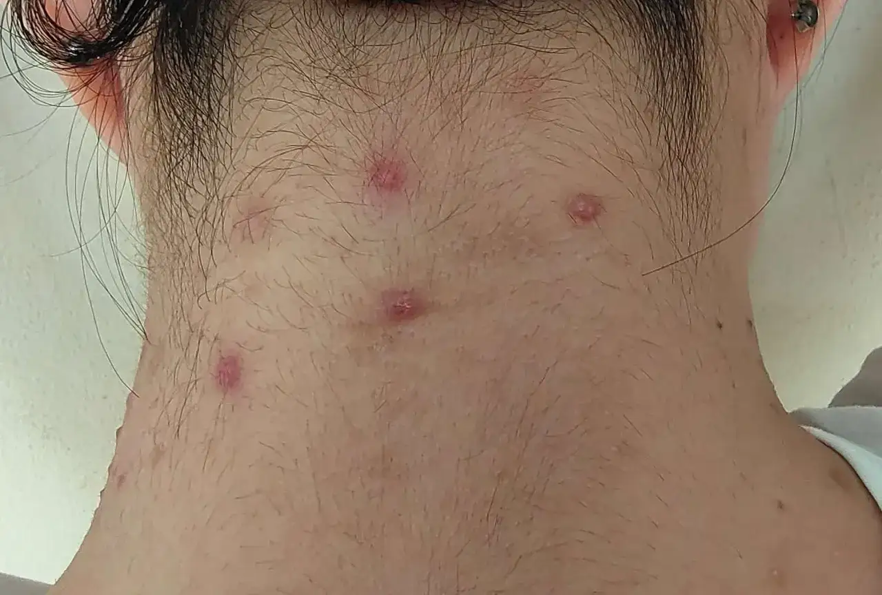 Rote, entzündete hautpickel am hals, einige mit weißer Spitze, unter dunklem Haar.