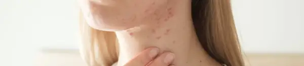 Hautpickel am Hals einer jungen Frau, die ihre Haut berührt.